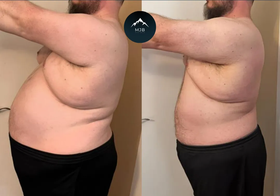 Bill, lost 70lbs and changed his life!